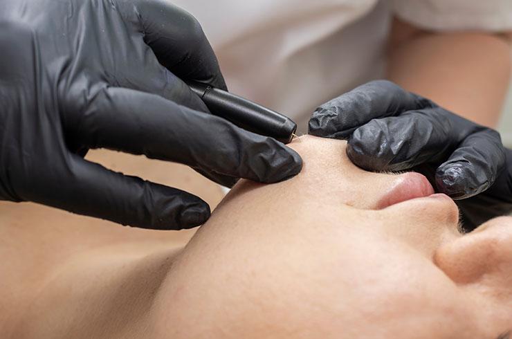 Épilation électrique définitive du visage par Thermolyse