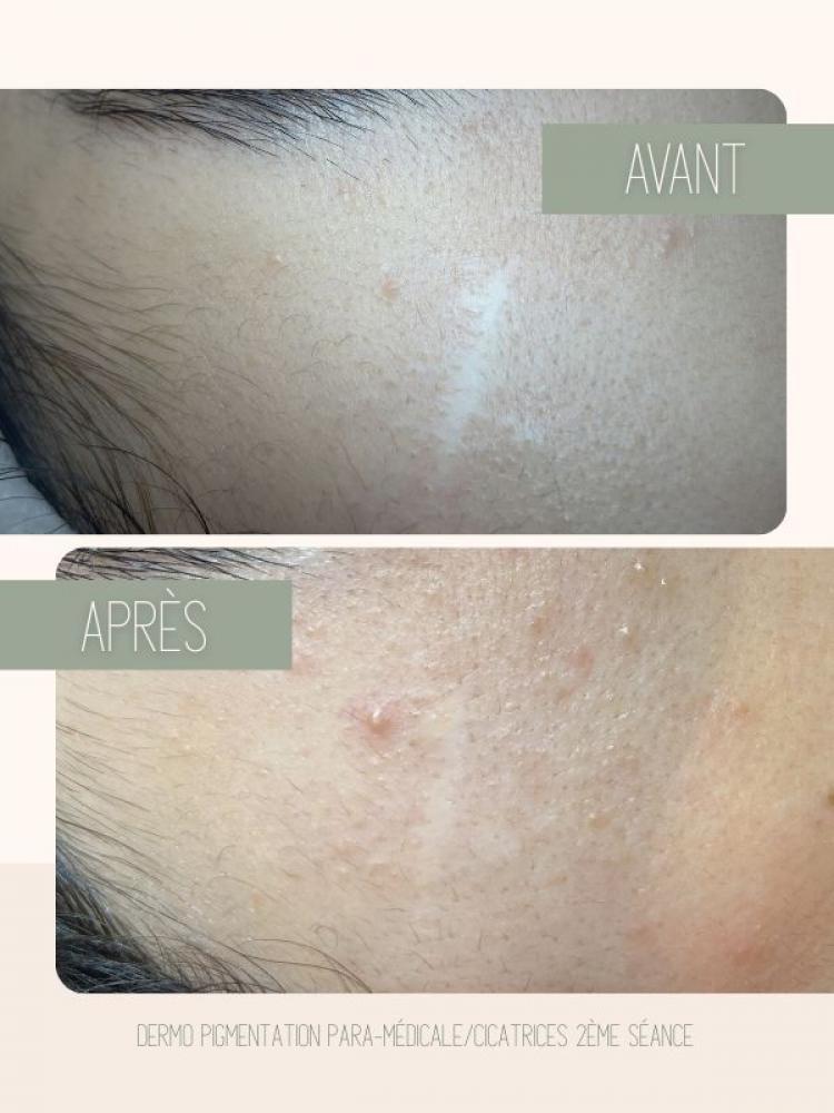 Dermopigmentation paramédicale Watermael-Boitsfort