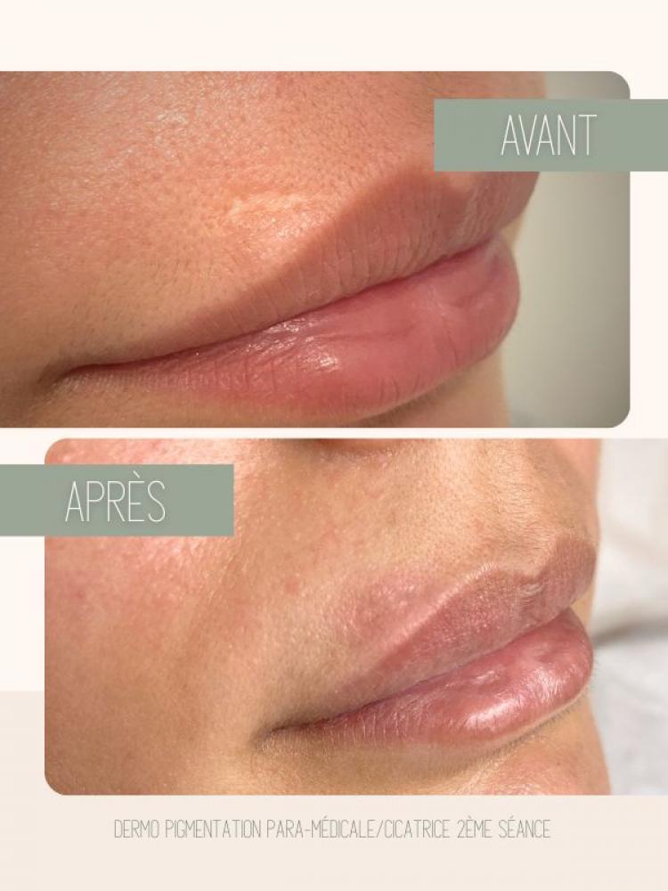Dermopigmentation paramédicale Watermael-Boitsfort
