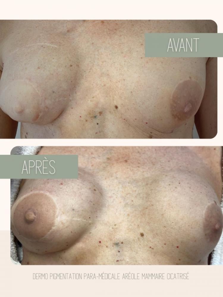 Dermopigmentation paramédicale Watermael-Boitsfort