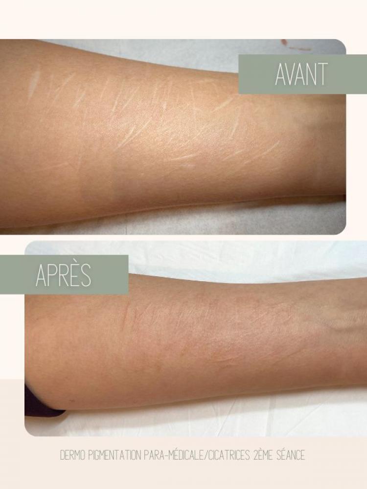 Dermopigmentation paramédicale Watermael-Boitsfort